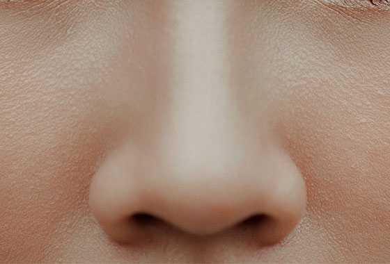 коррекция-носа-гиалуроновой кислотой
